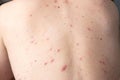 Closeup a man back who having varicella blister or chickenpox Royalty Free Stock Photo