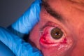Closeup of man eye with stye purging pus with doctor finger with blue glove