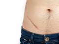 Closeup of man showing the stomach with a scar from appendicitis surgery