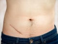 Closeup of man showing the stomach with a scar from appendicitis surgery