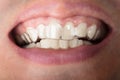 Man Wearing Transparent Teeth Aligners