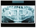 Closeup of man xray jaw for dental teeth doctor