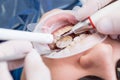 Closeup of modern professional teeth cleaning in dentistry with specialized equipment.