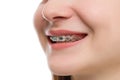 Closeup multicolored Braces on Teeth. Beautiful Female Smile portrait with Self-ligating Braces. Orthodontic Treatment.