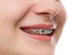 Closeup multicolored Braces on Teeth. Beautiful Female Smile portrait with Self-ligating Braces. Orthodontic Treatment.