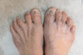 Closeup old Asian woman disease feet