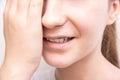 close up open mouth with iron bracket, teeth hurt and girl holds cheek with hand