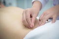 Closeup, patient getting acupuncture from acupuncturist