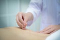 Closeup, patient getting acupuncture from acupuncturist