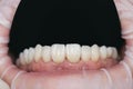 Closeup photo with zirconium artificial teeth. Zirconium crowns