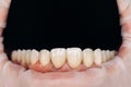 Closeup photo with zirconium artificial teeth. Zirconium crowns. Dental health care. Ceramic zirconium in final version