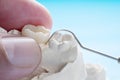 Prosthodontics or Prosthetic Royalty Free Stock Photo