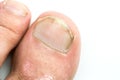 Closeup of Psoriasis vulgaris and fungus on the mans foot finger nails with plaque, rash and patches, on white background