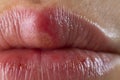 Closeup of Red bubbles of virus herpes on lips. Selective focus. Zoster, Cold, Medicine, Treatment. Horizontal Macro shot