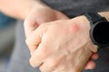 Closeup of red spot on skin of man hand Royalty Free Stock Photo