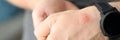 Closeup of red spot on skin of man hand Royalty Free Stock Photo