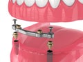 3d render of bar retained removable overdenture installation supported by two implants Royalty Free Stock Photo