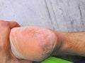 Closeup shot of cracked skin of heel of foot.Pedicure concept image