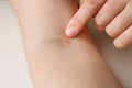 Closeup shot, forefinger points on vein injection mark on arm. Bruising and redness from syringe puncture. Patient or drug addict Royalty Free Stock Photo