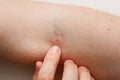 Closeup shot, forefinger points on vein injection mark on arm. Bruising and redness from syringe puncture. Patient or drug addict Royalty Free Stock Photo