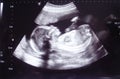 Closeup shot of an obstetric ultrasonography