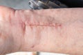 Closeup shot of a scar on a human's wrist