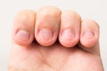 Closeup of skin peeling, fingers and nails bitten of a man. Health and medical concept