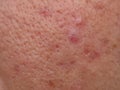 Skin problems, nodular cystic acne skin Royalty Free Stock Photo