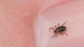 Male deer tick on nail of human finger detail. Ixodes ricinus