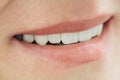 Closeup smile photo with zirconium artificial teeth. Zirconia bridge with porcelain.