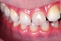 Closeup snapshot of teeth undergoing orthodontic treatment