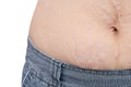 Closeup stretchmarks on woman belly Royalty Free Stock Photo