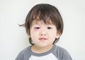 Closeup swollen eye of kid from insect bite with red bruise but he can smile