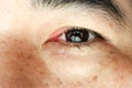 Closeup Swollen eyes or Blepharitis eyes of Asian man. Medicine and healthcare concept Royalty Free Stock Photo