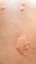 Closeup on symptoms of itchy urticaria