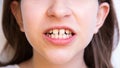 closeup teeth for children dentist and maxillofacial surgeon. clenched teeth