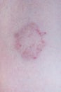 Closeup to First Step of Dermatophytosis/ Ringworm Symptom on Skin