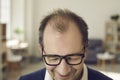 Closeup of top of head of cheerful balding mature man who needs hair loss treatment Royalty Free Stock Photo