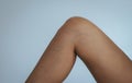 Closeup of varicose veins on the woman leg,Concept skin health