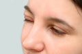 A closeup view on the eyes of a caucasian girl, with one eye close, painful, red and swollen from a hordeolum Royalty Free Stock Photo