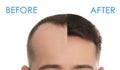 Closeup view of man before and after hair loss treatment on white background, collage. Banner design Royalty Free Stock Photo