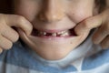 Closeup view of a toddler boy showing his missing milk teeth Royalty Free Stock Photo