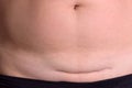 Closeup of woman belly with a scar from a cesarean section Royalty Free Stock Photo