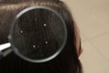 Closeup of woman with dandruff in her hair on blurred background Royalty Free Stock Photo