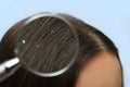 Closeup of woman with dandruff in her hair on color background Royalty Free Stock Photo