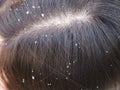 Closeup Woman with dandruff .