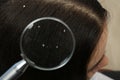 Closeup of woman with dandruff in her hair Royalty Free Stock Photo