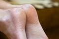 Closeup of woman feet sole with dry cracked skin. Foot and toes care concept Royalty Free Stock Photo