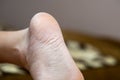 Closeup of woman feet sole with dry cracked skin. Foot and toes care concept Royalty Free Stock Photo