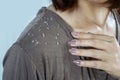 Closeup woman hair with dandruff scalp falling on shoulders Royalty Free Stock Photo